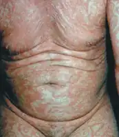 Erythema gyratum repens