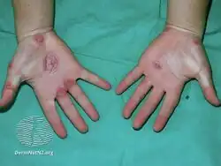 Erythema multiforme