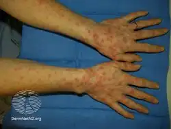 Erythema multiforme