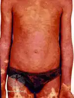 Erythrodermic psoriasis