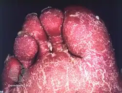 Erythrodermic psoriasis