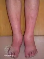 Erythromelalgia