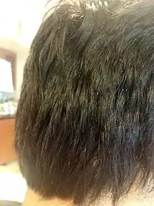 Severe dryness of scalp resulting in Dandruff.