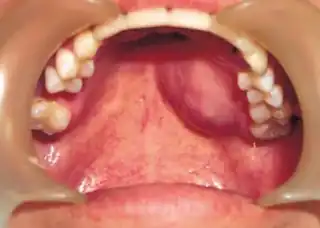 Extraskeletal Ewing sarcoma hard palate