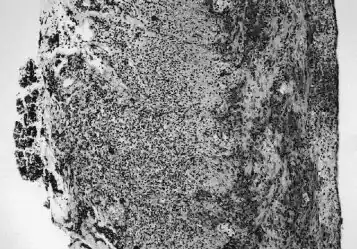 Histologic section demonstrating advanced necrotizing enterocolitis