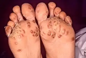 Keratoderma blennorrhagicum due to reactive arthritis