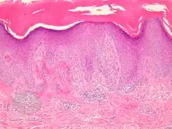 Inflammatory linear verrucous epidermal nevus-pathology