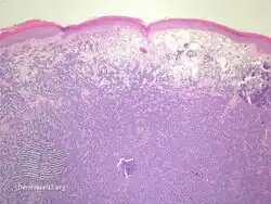 Merkel-cell carcinoma/pathology