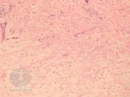 pathology-Papular mucinosis