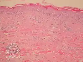 Paraneoplastic pemphigus/pathology