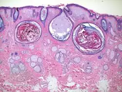 Favre–Racouchot syndrome-pathology