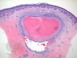 Trichilemmal cyst