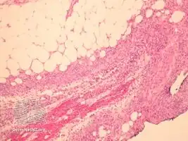 Alpha-1 antitrypsin deficiency panniculitis