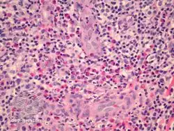 Angiolymphoid hyperplasia with eosinophilia/pathology