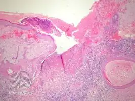 Blastomycosis-like pyoderma/pathology