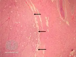 pathology-Fibrosarcoma