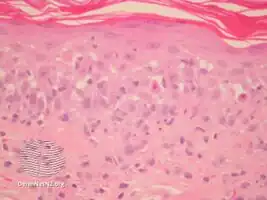 Paraneoplastic pemphigus/pathology