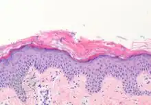 Histology: Malassezia spores (S) and filaments in outer skin layer