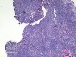 pathology-Eccrine spiradenoma