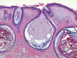 Favre–Racouchot syndrome-pathology