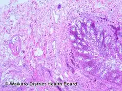 Cholesterol emboli/pathology