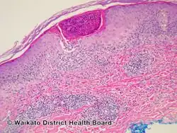 Eosinophilic folliculitis/pathology