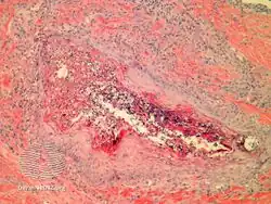 Perforating folliculitis/pathology