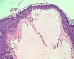 Lymphangioma circumscriptum/pathology