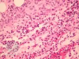 Alpha-1 antitrypsin deficiency panniculitis