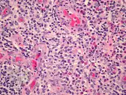 Angiolymphoid hyperplasia with eosinophilia/pathology