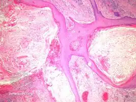 Blastomycosis-like pyoderma/pathology