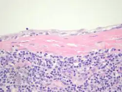 Branchial cleft cyst/pathology