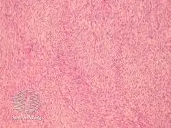 pathology-Fibrosarcoma