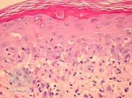 Graft-versus-host disease pathology