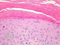 Inflammatory linear verrucous epidermal nevus-pathology