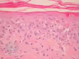 Paraneoplastic pemphigus/pathology