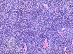 pathology-Eccrine spiradenoma