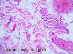 Cholesterol emboli/pathology