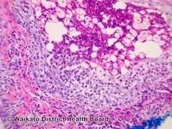 Eosinophilic folliculitis/pathology