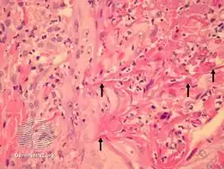 Perforating folliculitis/pathology