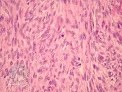 pathology-Fibrosarcoma