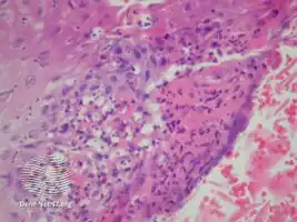 Blastomycosis-like pyoderma/pathology