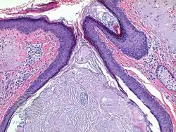 Favre–Racouchot syndrome-pathology