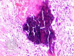 Trichilemmal cyst