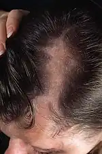 Frontal linear scleroderma