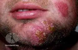 Tinea barbae (beard)