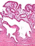 Micrograph of cholesterolosis of the gallbladder