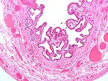 Micrograph of cholesterolosis of the gallbladder