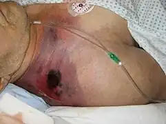 Gas gangrene of the shoulder.