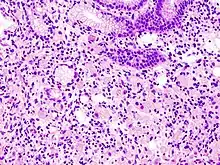 Gastric signet ring cell carcinoma. H&E stain.